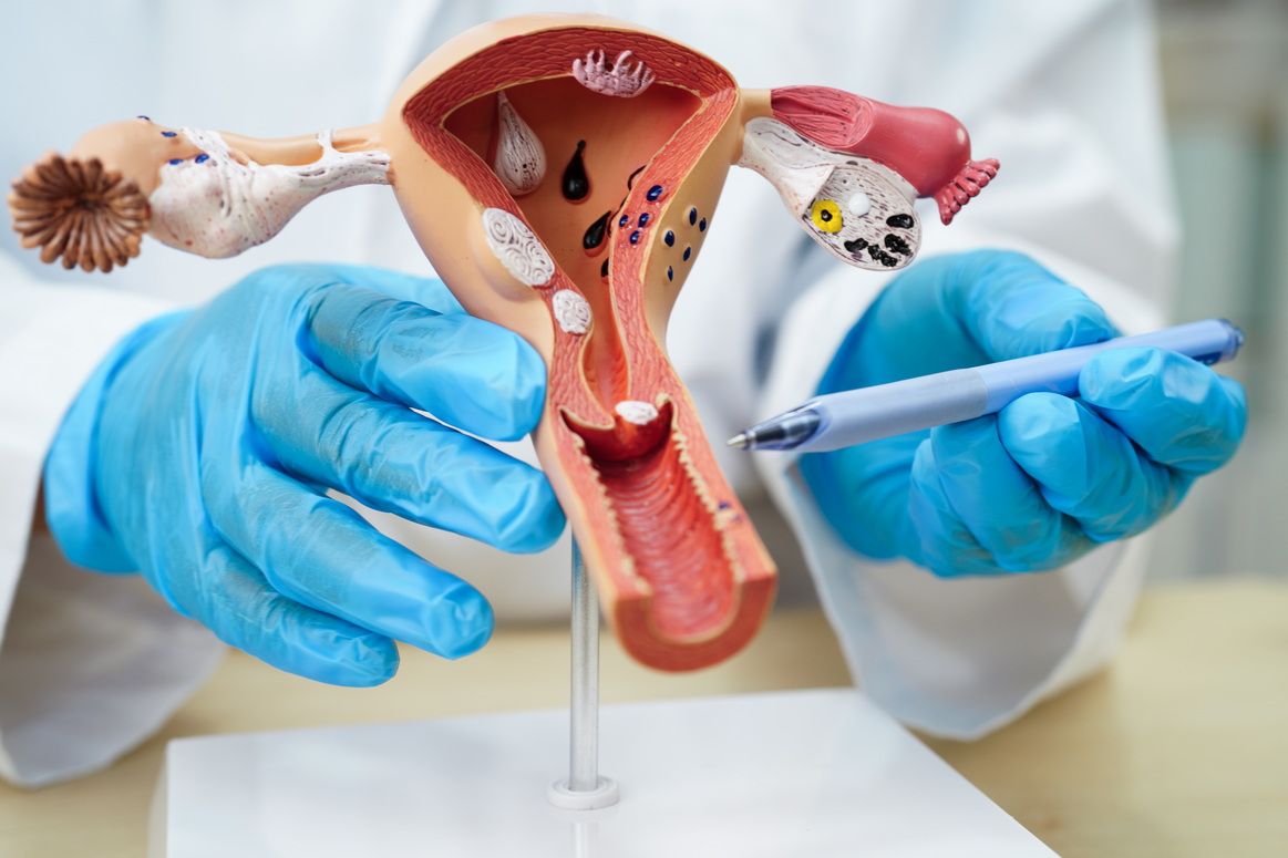 Гиперплазия эндометрия