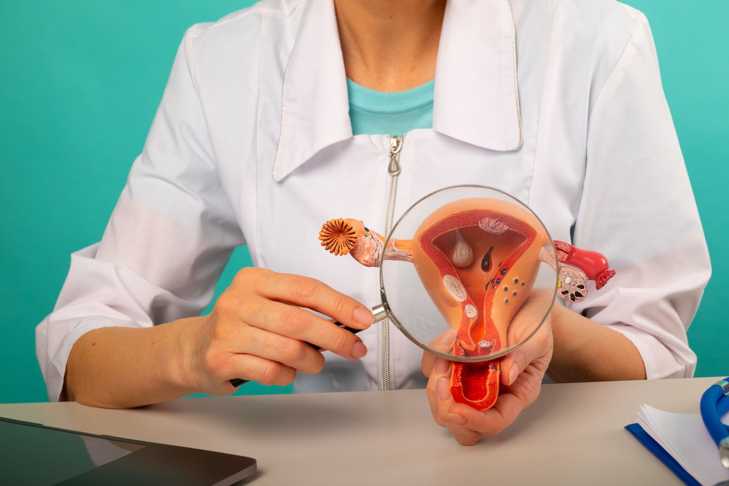 Миома матки